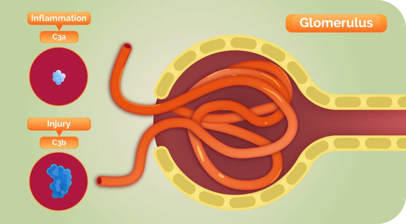 Graphic showing the Impact of C3G or primary IC-MPGN on your body